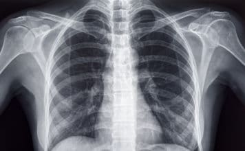 Chest X-ray of an Adult Female Human